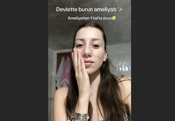 Devlet hastanesinde burun ameliyatı oldu! İşte genç kadının yaşadığı değişim