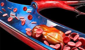 Uzun Covid’in Nedeni Olabilir: Fransız Araştırmacılar Anormal Pıhtılara Dikkat Çekti